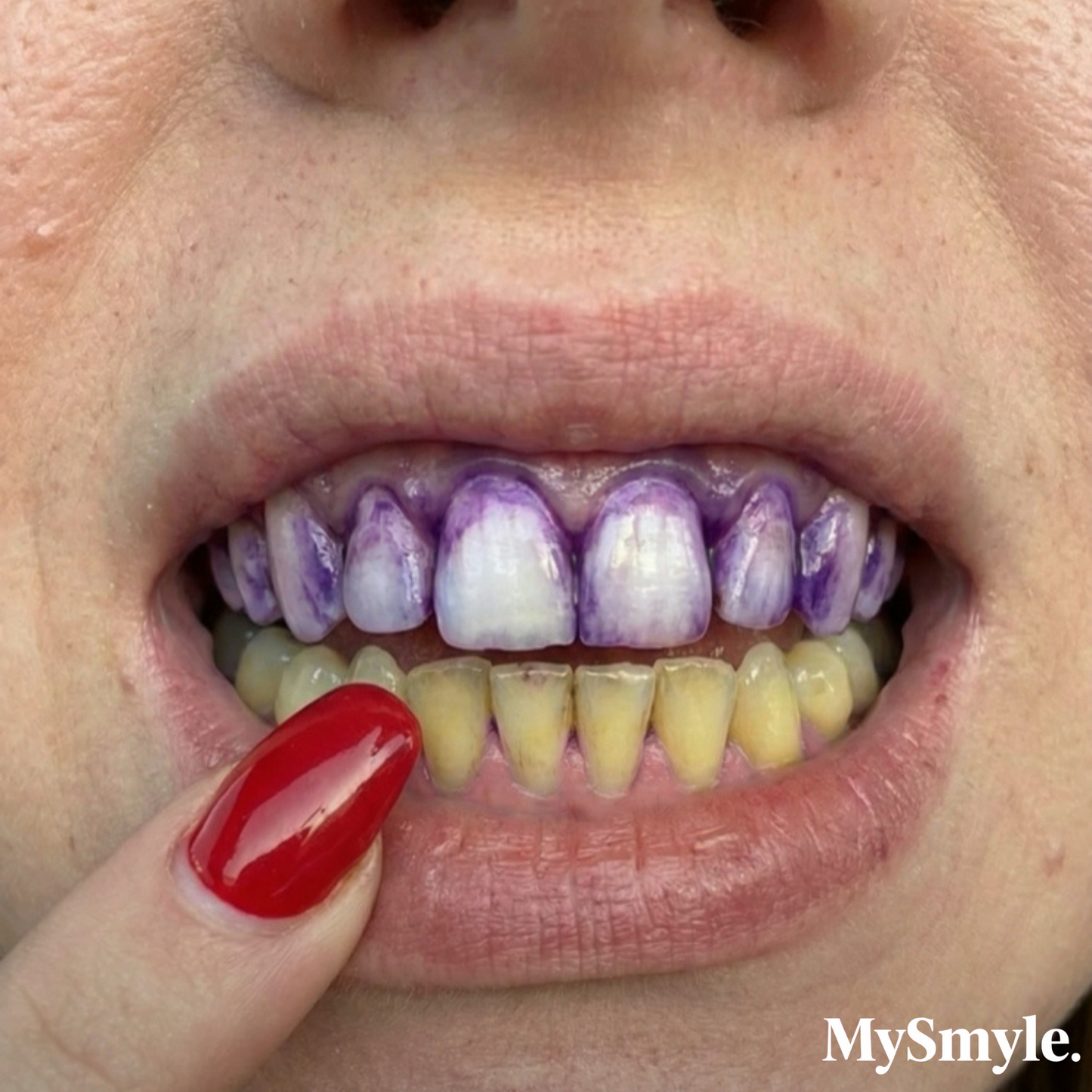 MySmyle Premium Paket 28x Şerit